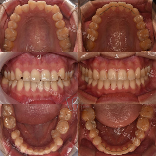 韩国le牙科牙齿矫正对比图