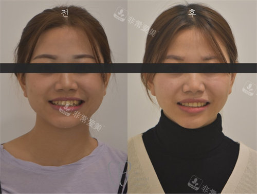 韩国le牙科牙齿矫正前后面部对比图