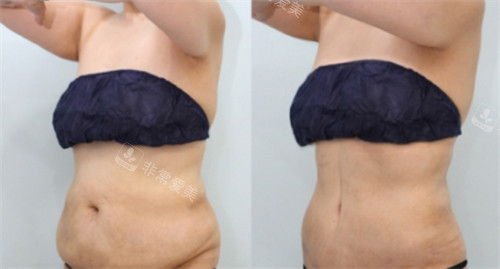 韩国TANGGLE整形外科腰腹吸脂前后图