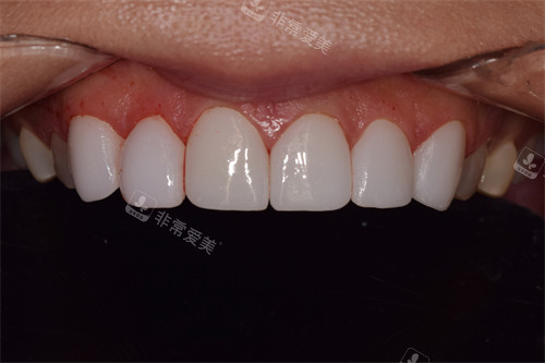 韩国SNOW牙科牙齿贴面术后图