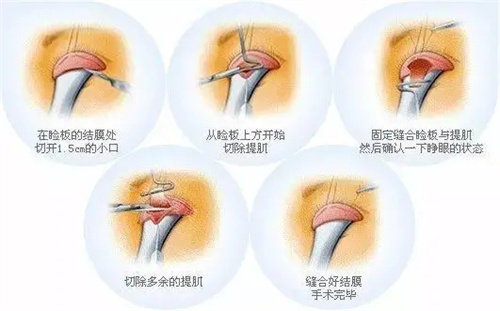 上睑下垂手术过程