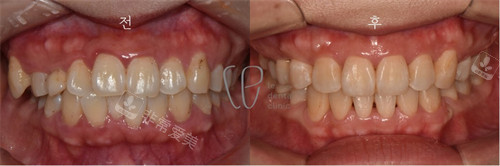韩国le牙科牙齿矫正前后图