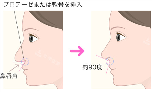鼻基底凹陷前后对比图