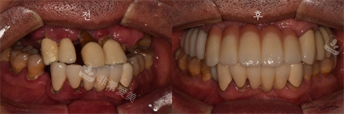 韩国Le牙科牙齿修复前后对比图