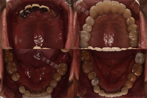 韩国Le牙科种植牙前后对比图