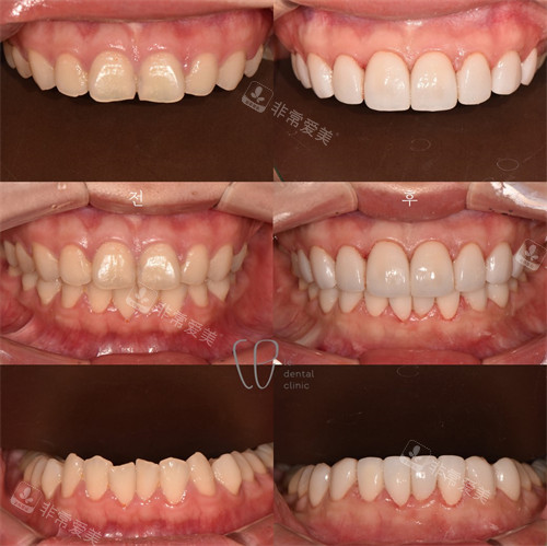 韩国Le牙科牙齿贴面前后图片