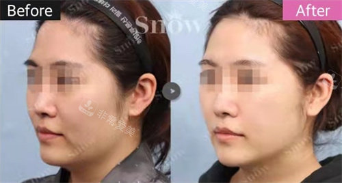 韓國snow整形面部吸脂+回填法令紋手術側面對比圖 韓國snow整形面部吸脂+回填法令紋手術側面對比圖