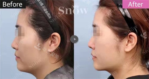 韩国snow整形面部吸脂+回填法令纹手术侧面对比图