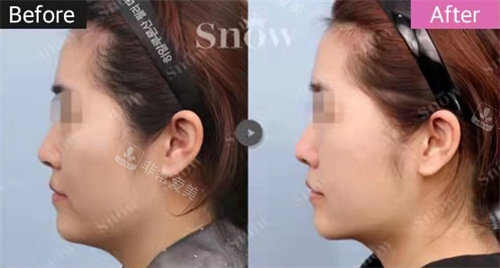 韓國snow整形面部吸脂+回填法令紋手術側面對比圖 韓國snow整形面部吸脂+回填法令紋手術側面對比圖