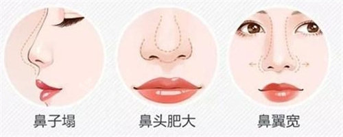 鼻部整形问题展示图