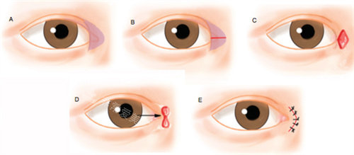 开内眼角过程图解