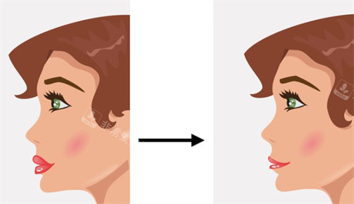 注射玻尿酸丰唇前后的区别图解