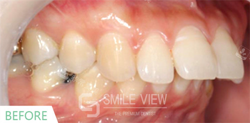 smile view牙科牙齿矫正手术对比图术前