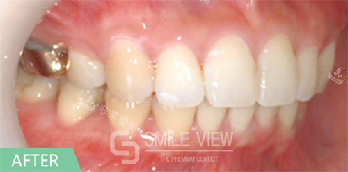 smile view牙科牙齿矫正手术对比图术后