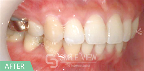 smile view牙科牙齒矯正手術(shù)對(duì)比圖術(shù)后