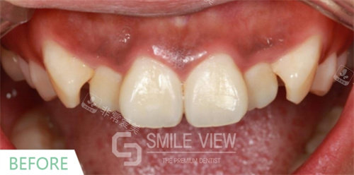 韓國SMILE VIEW牙科牙齒矯正前 韓國SMILE VIEW牙科牙齒矯正前