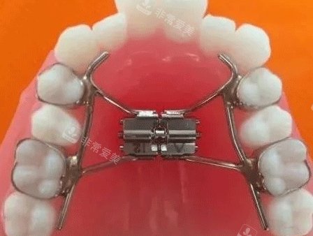 牙齿扩弓器照片
