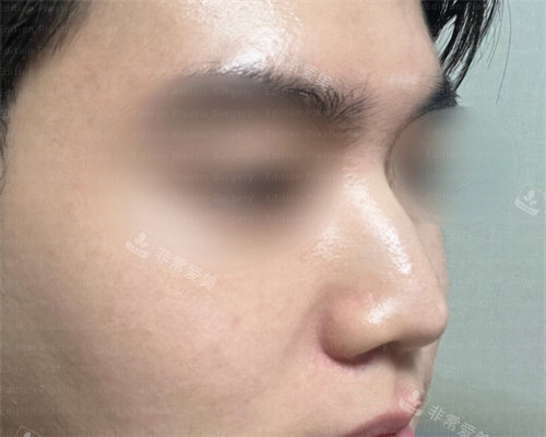 韩国艾迪升整形外科隆鼻术前图
