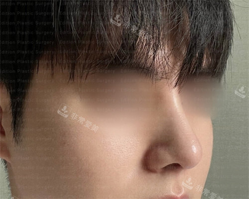 韩国艾迪升整形外科隆鼻术后图