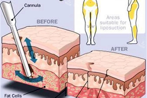 吸脂抽吸部位图解