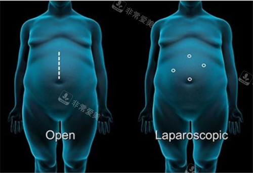 袖状胃切除手术动画图示
