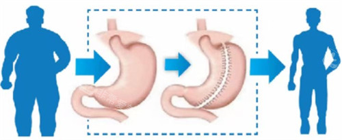 袖状胃切除手术图示