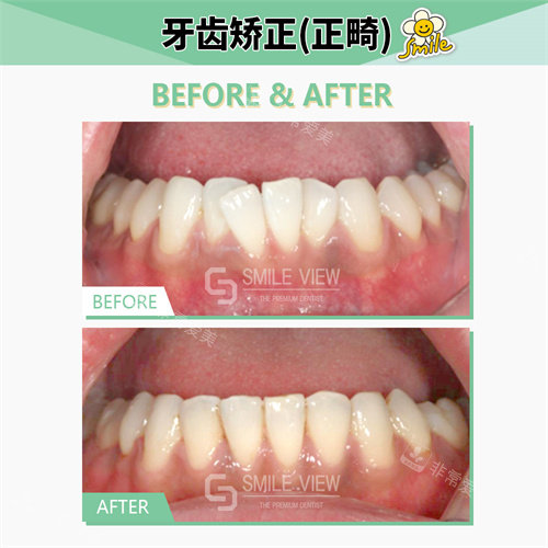 smile view牙科矯正<span style= smile view牙科矯正<span style=