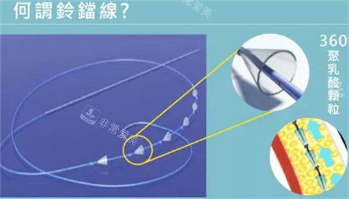 韩国铃铛线提升术后提拉感强吗?韩国madeu皮肤科的朴在友医生为你解答!