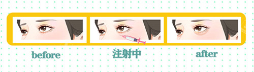 玻尿酸丰卧蚕