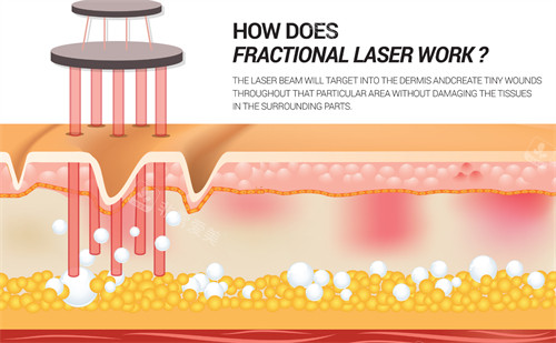 激光祛斑在皮肤内部的作用