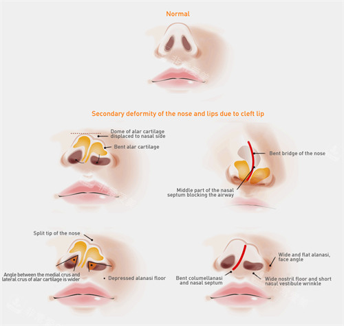 修复鼻孔不对称