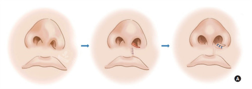 手术改善鼻孔和鼻翼不对称
