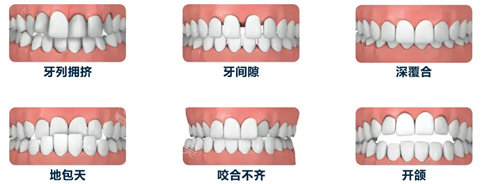 牙齿矫正的六种情况