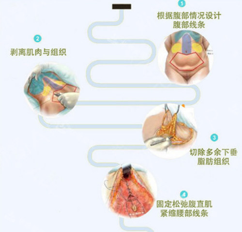 腹壁成型术过程图