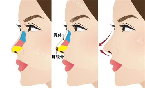 耳软骨隆鼻动画图