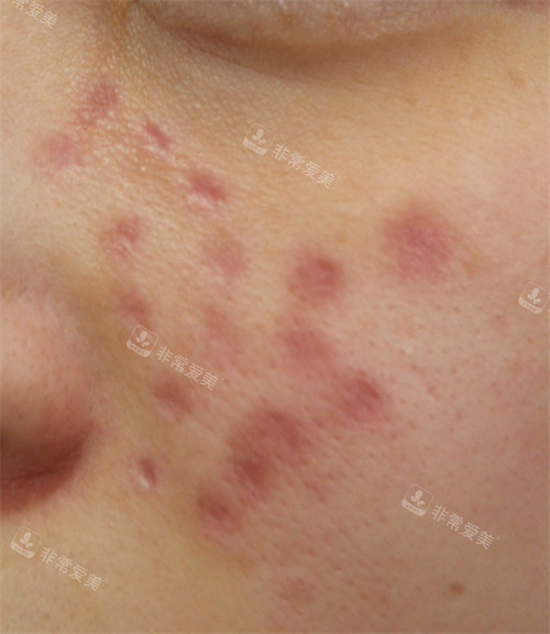 在韩国露潭韩医院治疗前由于药物导致的副作用疤痕的样子图片