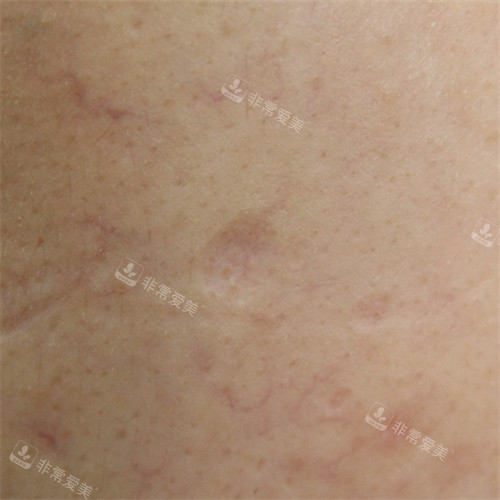 韩国露潭韩医院CORA疗法前由于水痘造成的疤痕图片