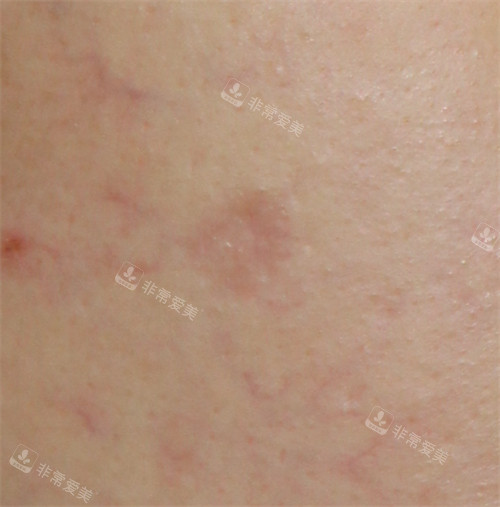 韩国露潭韩医院CORA疗法治疗水痘疤痕6次后皮肤的样子图片