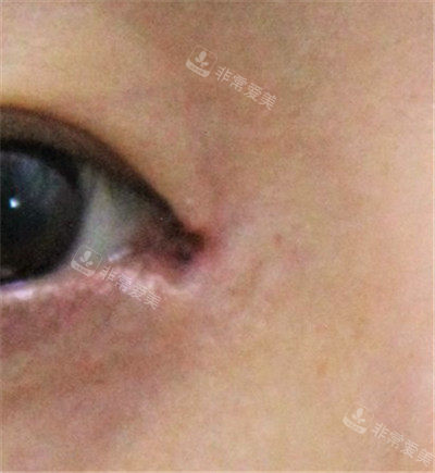 前眼角疤痕治療前 前眼角疤痕治療前
