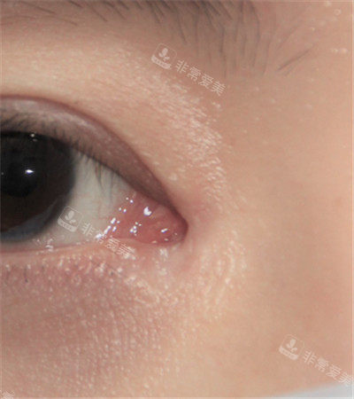 前眼角整形疤痕 10次治療后<span style= 前眼角整形疤痕 10次治療后<span style=