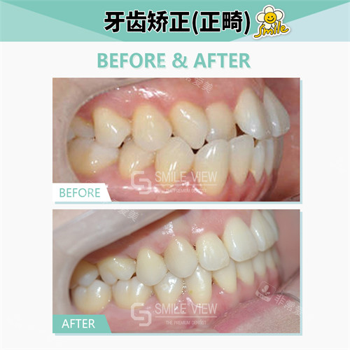 江南SMILE VIEW牙科正畸前后對(duì)比