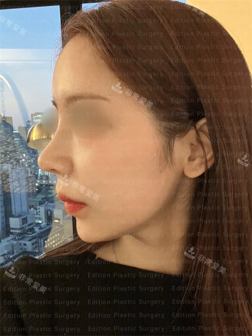 艾迪升整形外科鼻修復(fù)術(shù)后圖 艾迪升整形外科鼻修復(fù)術(shù)后圖