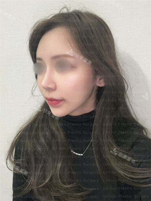 艾迪升整形外科鼻修復(fù)術(shù)后照片 艾迪升整形外科鼻修復(fù)術(shù)后照片