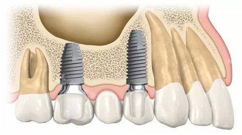 种植牙动画图