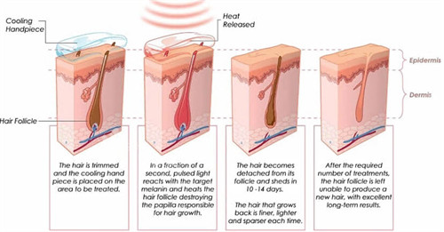 激光脱毛原理过程