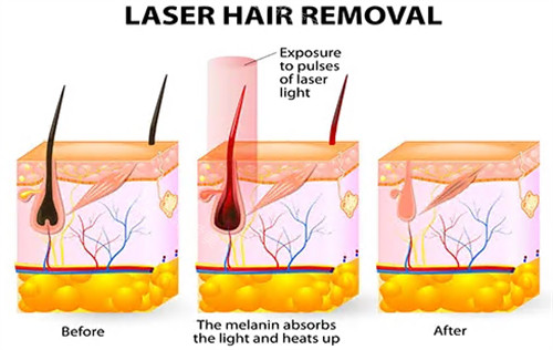 激光脱毛原理图