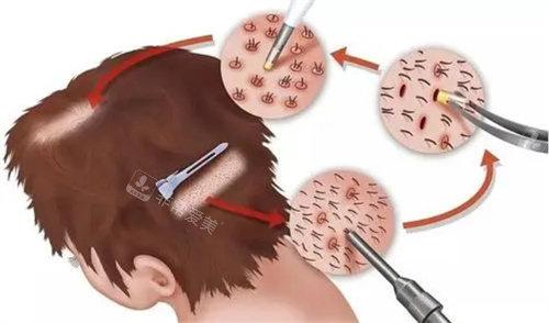毛发移植手术动画图