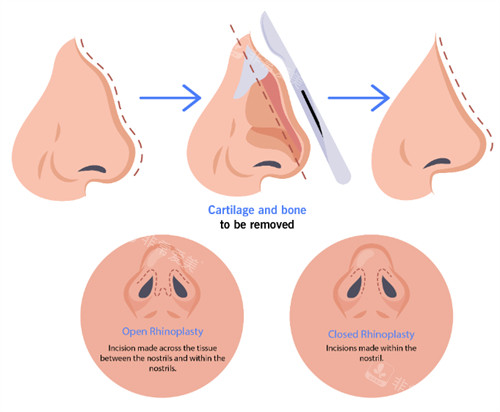 驼峰鼻矫正手术过程