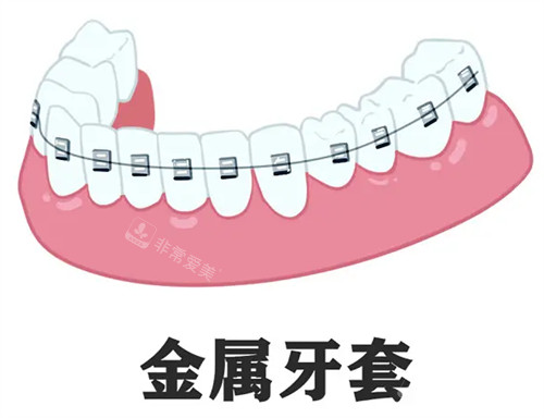 矫正牙齿用的金属牙套