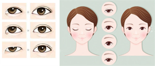 不同眼型双眼皮手术前后图片